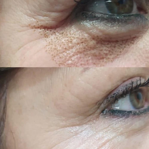 Levantar párpados caídos sin cirugía