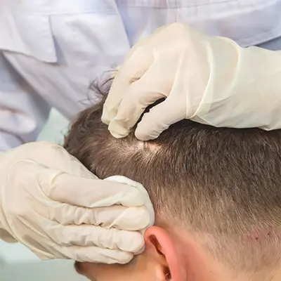 Beneficios PRP Capilar